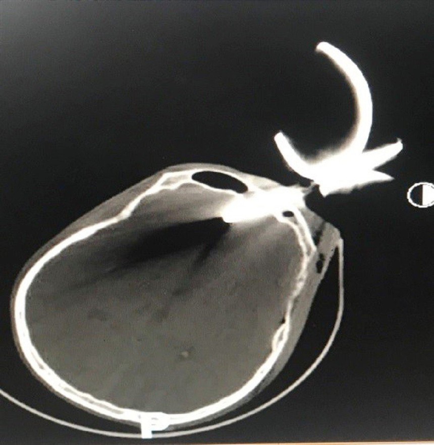 Thành phố Hồ Chí Minh: Cứu sống người đàn ông bị dị vật kim loại cắm vào hộp sọ - Ảnh 1. Thành phố Hồ Chí Minh: Cứu sống người đàn ông bị dị vật kim loại cắm vào hộp sọ - Ảnh 1.