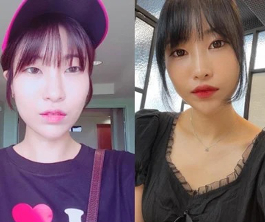 Những ngôi sao K-biz biến dạng vì phẫu thuật thẩm mỹ: Park Bom, Hong Soo Ah...  - Ảnh 6.