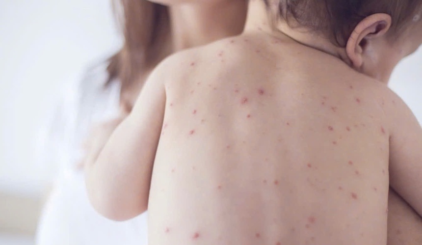 Thành phố Hồ Chí Minh: Số lượng ca mắc sốt xuất huyết cao nhất khu vực phía Nam - Ảnh 2. Thành phố Hồ Chí Minh: Số lượng ca mắc sốt xuất huyết cao nhất khu vực phía Nam - Ảnh 2.