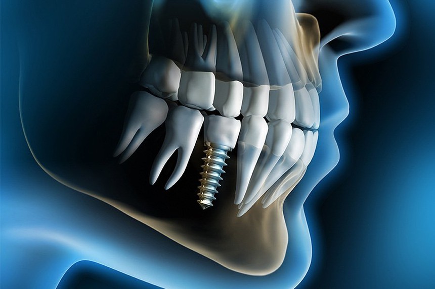 Trồng răng implant có gây đau hay xảy ra biến chứng? - Ảnh 1. Trồng răng implant có gây đau hay xảy ra biến chứng? - Ảnh 1.