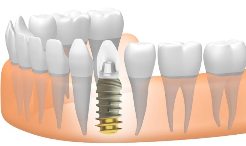 Trồng răng implant có gây đau hay xảy ra biến chứng? - Ảnh 2. Trồng răng implant có gây đau hay xảy ra biến chứng? - Ảnh 2.