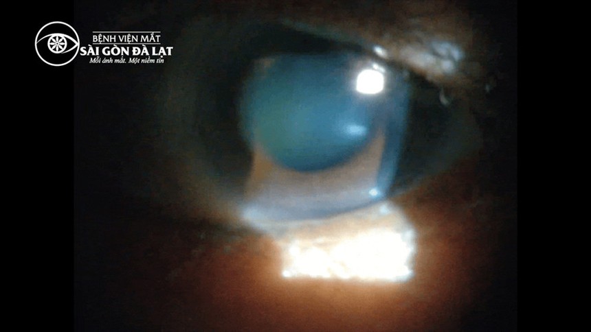 Mất thị lực vì sợi dây thun! - Ảnh 1.