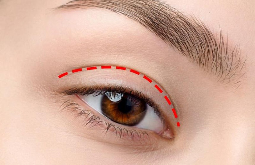 Nhấn mí mắt có an toàn không? Giá bao nhiêu? - Ảnh 1. Nhấn mí mắt có an toàn không? Giá bao nhiêu? - Ảnh 1.