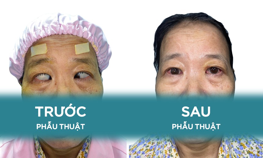 Phẫu thuật thành công ca bệnh lác bẩm sinh hiếm gặp - Ảnh 1. Phẫu thuật thành công ca bệnh lác bẩm sinh hiếm gặp - Ảnh 1.