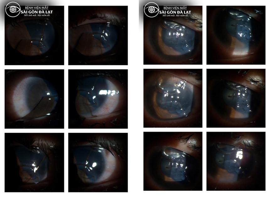 Chấn thương gây mất thị lực vì mảnh ghế nhựa bắn vào mắt - Ảnh 1.