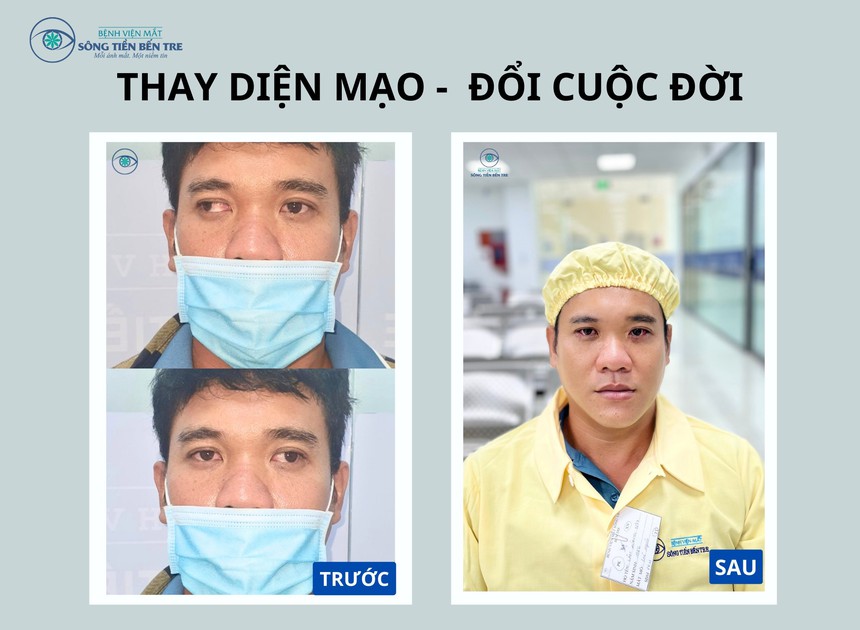Hành trình 3 giờ sáng vượt 120 km bằng xe máy để chữa trị lác (lé) - Ảnh 1. Hành trình 3 giờ sáng vượt 120 km bằng xe máy để chữa trị lác (lé) - Ảnh 1.