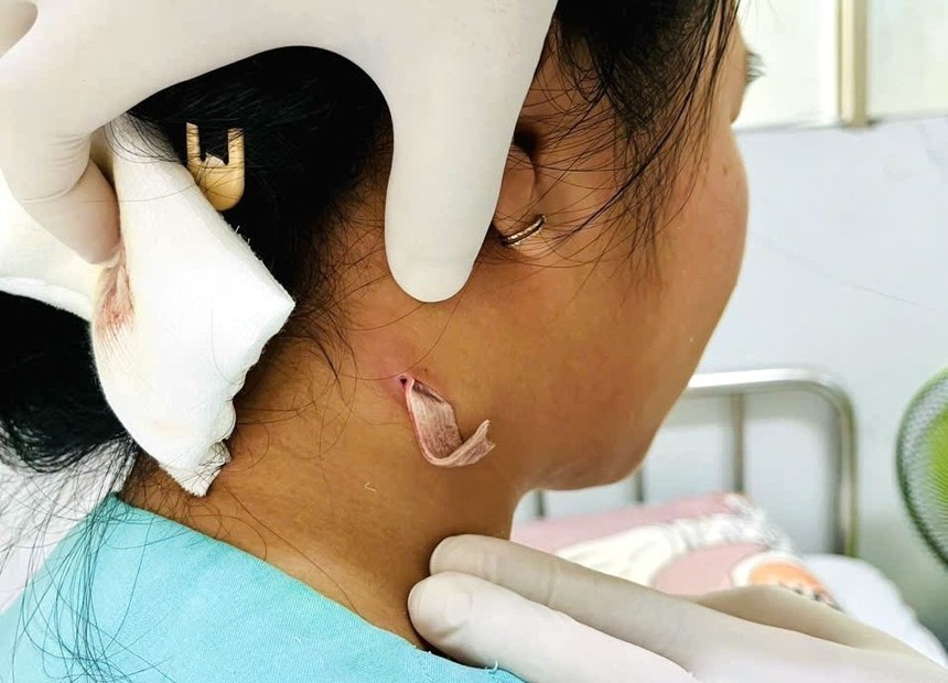 Ghi nhận bệnh nhi 14 tuổi nhiễm vi khuẩn gây bệnh Whitmore - Ảnh 1. Ghi nhận bệnh nhi 14 tuổi nhiễm vi khuẩn gây bệnh Whitmore - Ảnh 1.