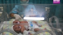 VIDEO: Rơi nước mắt trước bé sơ sinh hai đầu ở Indonesia