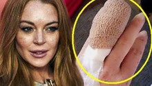 SỐC: Lindsay Lohan mất nửa ngón tay vì tai nạn
