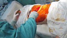 HY HỮU: Bác sỹ để quên kéo trong bụng bệnh nhân 18 năm