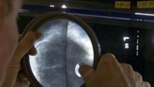 Tranh cãi quanh việc phương pháp chụp X-quang chẩn đoán ung thư vú