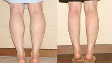 5 thói quen hàng ngày giúp bạn thoát khỏi đôi chân "cột đình", làm đúng và đủ còn giảm hẳn 3cm vòng đùi