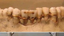 Niềng răng là phát minh từ thời cổ đại và chỉ người đã khuất mới niềng răng