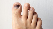 Người gan kém thường gặp 3 vấn đề này ở bàn chân, mong rằng bạn không có dù chỉ là 1 điểm