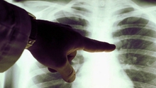 2 yếu tố tăng nguy cơ mắc ung thư phổi đang 'bủa vây' người Việt: Phòng tránh thế nào?