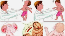 Cứu sống bé trai 4 tháng tuổi xuất huyết não do bị người thân bế xốc, rung lắc mạnh
