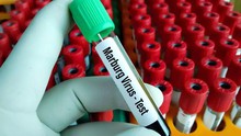 Bộ Y tế yêu cầu giám sát dịch Marburg có khả năng tử vong lên tới 88%: Nắm rõ ngay con đường lây truyền và dấu hiệu mắc bệnh để phòng ngừa 