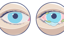 Nguyên nhân và cách phòng ngừa lây lan bệnh đau mắt đỏ