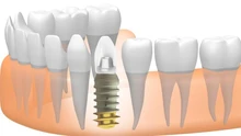 Trồng răng implant có gây đau hay xảy ra biến chứng?