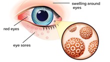 Herpes mắt là gì?