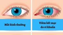 Viêm kết mạc và những điều cần biết (Phần 1)