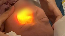 Bé gái 4 tuổi bỏng mắt vì cồn rửa tay khi đi du lịch ở Đà Lạt
