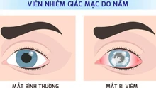 Viêm loét giác mạc do nấm - hiểm họa âm thầm có thể gây mù lòa