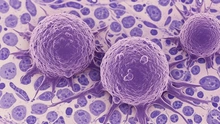 Xét nghiệm máu siêu nhạy của Johns Hopkins phát hiện ADN ung thư sớm 3 năm