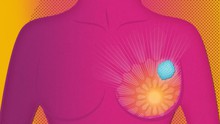 AstraZeneca công bố đột phá của thuốc điều trị ung thư vú