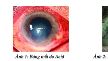 Bỏng mắt do hóa chất - 15 phút sơ cứu để cứu sáng đôi mắt