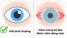 Bệnh lý nhãn viêm đồng cảm