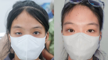 Phẫu thuật sụp mi bẩm sinh thành công, bé gái lấy lại ánh nhìn trước thềm lớp 9