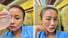 Hot girl của ĐT nữ Việt Nam 'khoe' khuôn mặt bầm tím vì chấn thương sau trận ra quân ở giải VĐQG 