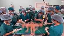 Bác sĩ 8 bệnh viện lớn tại TP.HCM cùng tham gia cuộc 'đại phẫu' cho cặp song sinh dính nhau