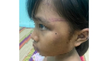 Xác minh vụ việc một bé gái 7 tuổi nghi bị bạo hành ở Bình Phước