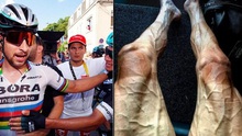 Cua rơ Tour de France khoe bắp chân CHẰNG CHỊT mạch máu