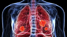 Tỷ lệ nữ giới châu Á không hút thuốc mắc ung thư phổi tăng
