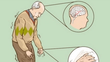 Các nhà khoa học Bỉ giải mã thành công bệnh Parkinson