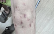 Khi đau gối được chữa bằng… "dao rạch thoát khí độc"