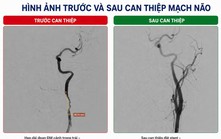 Nhồi máu não cấp sau khi chơi bóng đá do tổn thương động mạch cảnh