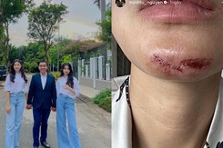 Sao Việt 19/6: Mạnh Trường, Quyền Linh khoe con gái, Minh Tú bị rách cằm khi đi làm