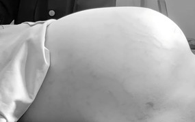 Phẫu thuật thành công khối bướu buồng trứng nặng 15 kg ở bé gái 14 tuổi