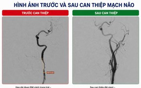 Nhồi máu não cấp sau khi chơi bóng đá do tổn thương động mạch cảnh