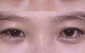 Hành trình tìm lại ánh nhìn duyên và sự tự tin nhờ vào phẫu thuật điều trị lác (lé)