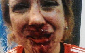 Fan nữ Argentina bị CĐV đối thủ đánh biến dạng mặt mày