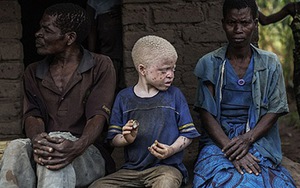 Hãi hùng nạn giết người bạch tạng tế lễ ở châu Phi