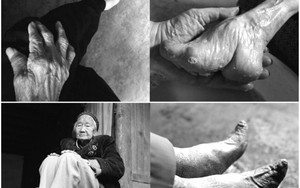 Những bức ảnh lột trần nỗi kinh hoàng của tục bó chân