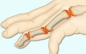 Cấp cứu kịp thời ngư dân bị đứt rời đốt ngón tay hy hữu