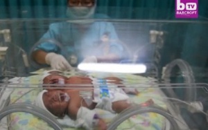 VIDEO: Rơi nước mắt trước bé sơ sinh hai đầu ở Indonesia