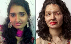 Khuôn mặt biến dạng vì bị tạt a-xít lên sân khấu Tuần lễ Thời trang New York